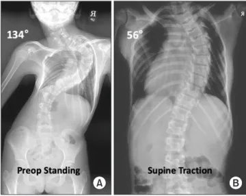 Figure 2. An eleven-year-old girl had severe scoliosis. (A) Preoperative   (preop) standing radiograph demonstrates a 134° major curve