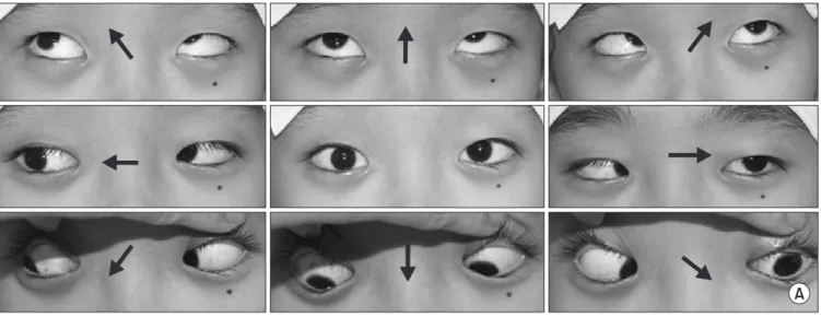 Figure 3. (A) She presented with the complaint of binocular horizontal diplopia worse in the left gaze at 22 days after halo-pelvic traction