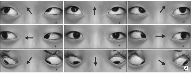 Figure 4. (A, B) At the two-month follow-up after corrective surgery of severe scoliosis, the binocular diplopia by sixth cranial nerve palsy had  completely resolved by simple observation, and she was free of symptoms