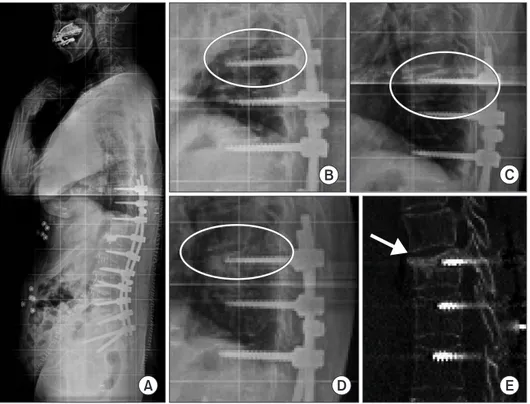 Figure 1. (A) Postoperative simple radio- radio-graphy of a 72-year-old female after  2 weeks of L1–S1 anterior interbody  fusion and T10–S1 posterior fixation