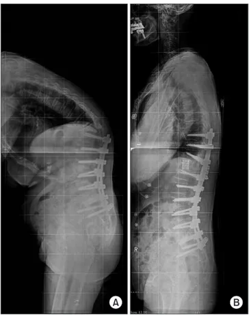 Figure 2. (A) Postoperative simple radiography of an 80-year-old female  8 months after L3–S1 anterior interbody fusion and L1–S1 posterior  fixation, presents proximal junction failure and kyphosis