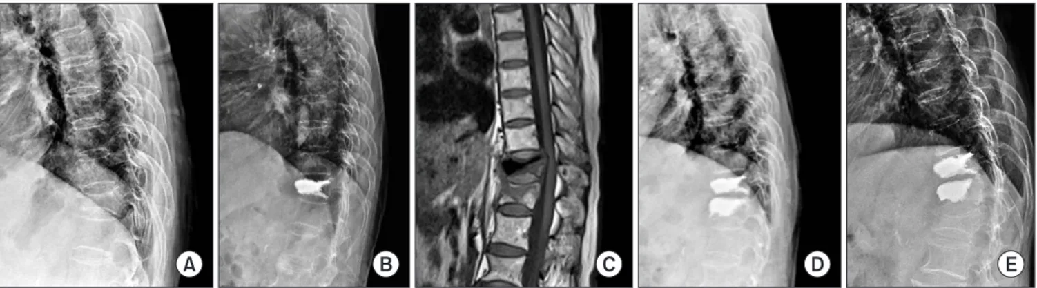 Figure 1. A 73-year-old female. Plain radiograph shows T11 compression fracture (A) and treated  via percutaneous vertebroplasty (B)