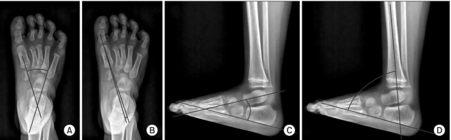 Figure 1. (A) Talo-calcaneal angle on the anteroposterior view. (B) Talo-1st metatarsal angle on the anteroposterior view