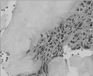 Figure 5. Tophi crystals are surrounded by inflammatory cells including  macrophages, lymphocytes, foreign body giant cells (H&amp;E, ×400)
