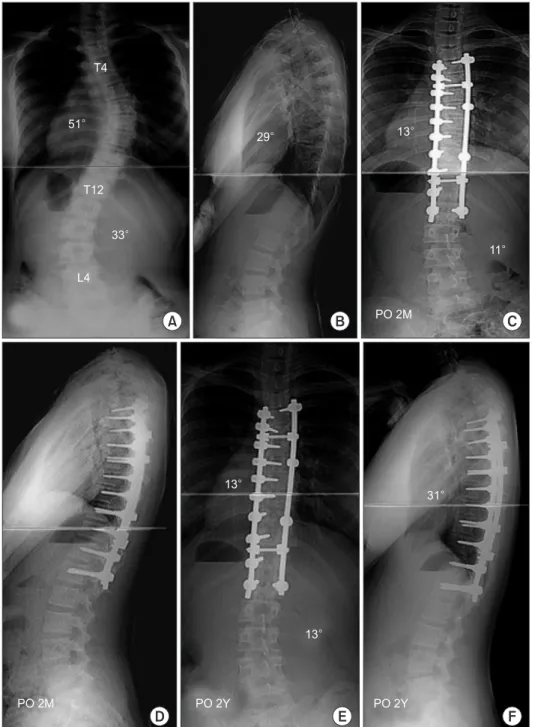 Figure 1. Thirteen-year-old girl with  single thoracic curve. (A) Preoperative  anterolateral radiograph showed the main  thoracic curve of 51° and the lumbar  curve of 33°