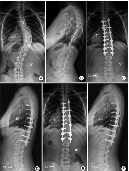 Figure 2. Fourteen-year-old girl with  single thoracic curve. (A) Preoperative  anterolateral radiograph showed the main  thoracic curve of 48° and the lumbar  curve of 24°