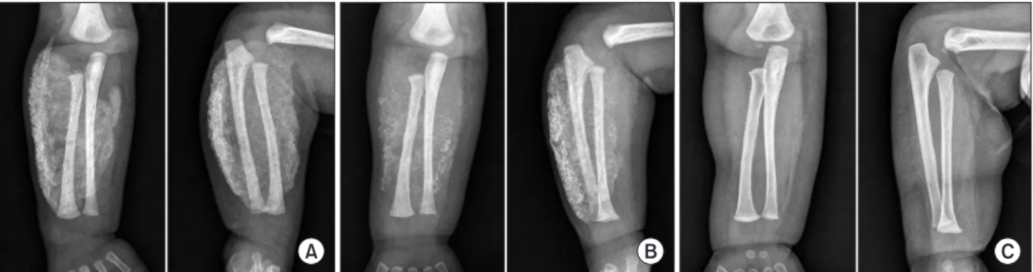 Figure 2. (A) Radiographs from a 26-day-old girl, show a huge, diffuse, scattered calcification of the right forearm