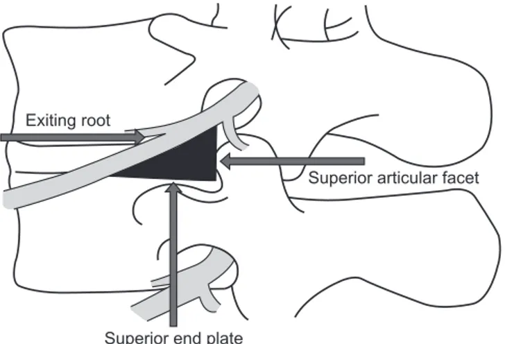 Figure 1. Kambin’s triangle: the exiting root is the hypotenuse, the  superior border of the lower vertebral body is the base, and the height is  the superior articular facet