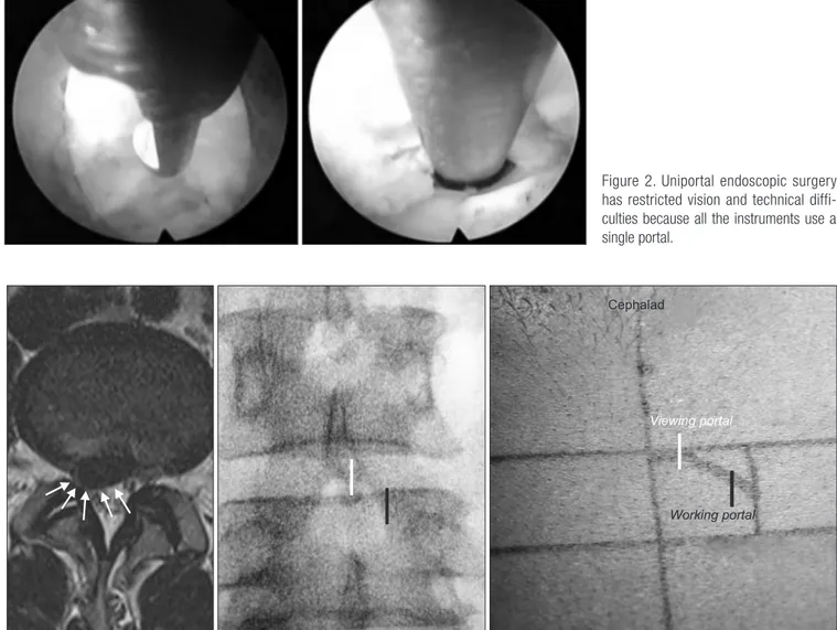 Figure 2. Uniportal endoscopic surgery  has restricted vision and technical  diffi-culties because all the instruments use a  single portal.