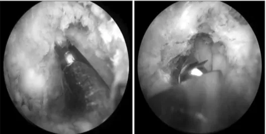 Figure 4. One portal is used for arthroscopic viewing and continuous  irrigation, and the other is used for the insertion and manipulation of  instruments