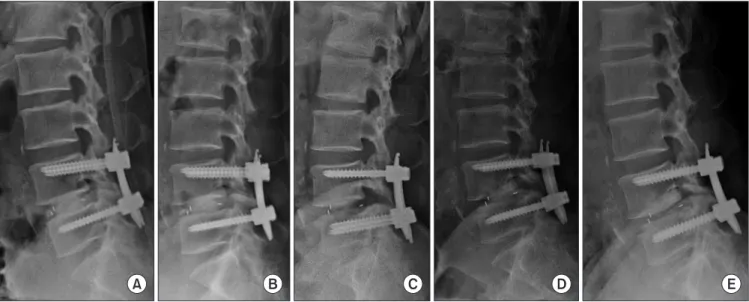 Figure 1. Posterior migration of the cage. Postoperation (A), 3 months after operation (B), 6 months after operation (C), 9 months after operation (D),  12 months after operation (E).