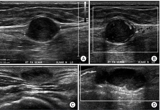 Figure 3. Sonographic images of schw- schw-annoma. (A) Longitudinal forearm  ultrasound shows a fusiform  hetero-geneous, hypoechoic mass in continuity  with the ulnar nerve with posterior  acoustic enhancement