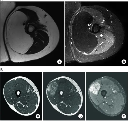 Figure 5. Magnetic resonance imagings  (MRIs) of lipoma (A), liposarcoma (B,  pleomorphic)