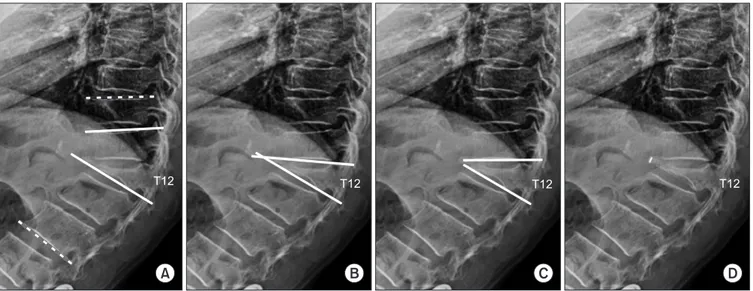 Figure 1. Evaluation of the radiographic parameters. (A) Kyphosis angle (dotted lines): Most kyphotic Cobb’s angle including fractured vertebra (°),  instrumented angle (solid lines): Cobb’s angle of instrumented vertebra (°)