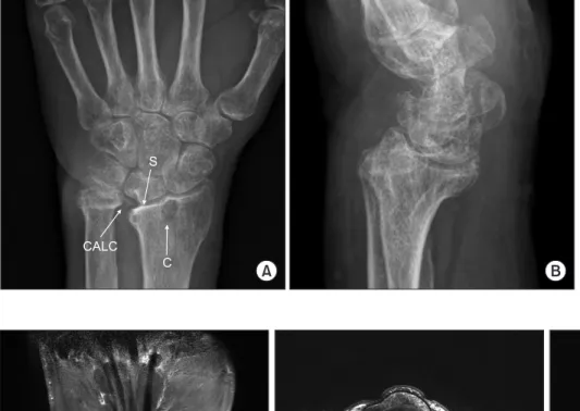 Figure 2. (A) In T1-weighted coronal magnetic resonance imaging, a large cystic mass through the flexor tendon sheath was observed, showing  intermediate signal intensity