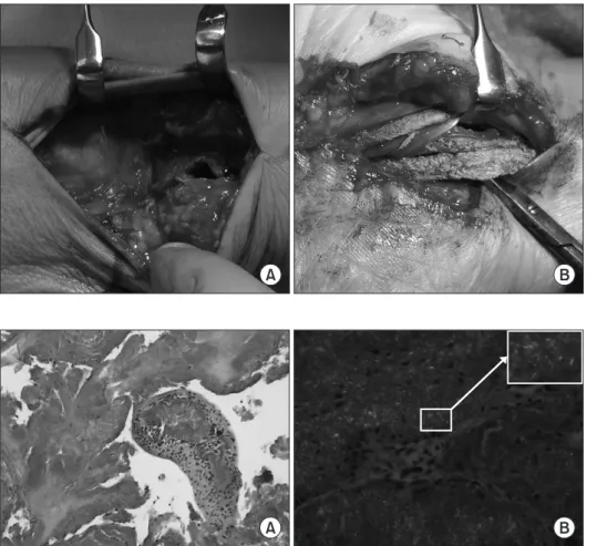 Figure 3. (A) In the dorsal approach,  disruption of the distal interosseous  membrane at the forearm was observed