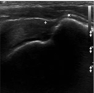 Figure 3. Ultrasonography of the short axis of the SPP showing cartilage  interface sign’ with the hyperechoic line of the articular cartilage  (arrows)