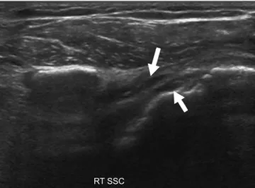Figure 6. Ultrasonography of the long axis of the SSC showing  hypoechoic defects (arrows)
