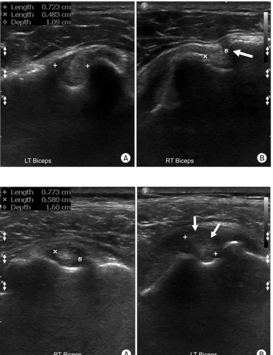 Figure 8. Ultrasonography of the short  axis of the long head of biceps tendon  showing normal width (LT) (A) and narrow  width (RT) (arrow) (B) of the bicipital  groove