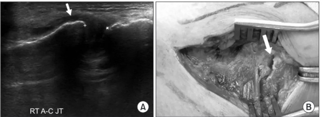 Figure 10. Injury of the A-C JT. (A) Ultra- Ultra-sonography of the A-C JT showing a  widened joint space (between two crosses)  and fluid (arrow)