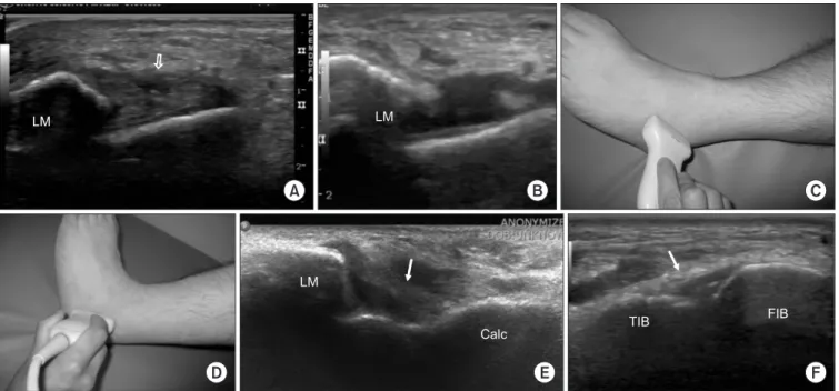 Figure 1. Ultrasonography images showing the sprained ankle ligaments. (A) An ultrasonography image shows a small defect (arrow) in the middle  portion of the swollen anterior talofibular ligament, which is consistent with a mild to moderate sprain