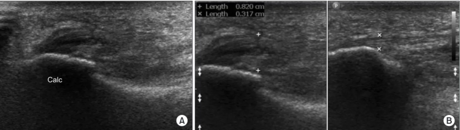 Figure 2. (A) Long-axis ultrasonography image shows moderate swelling of the plantar fascia in the calcaneal insertion site