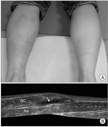 Figure 5. Long-axis ultrasonography image shows complete rupture and  gap formation of the Achilles tendon
