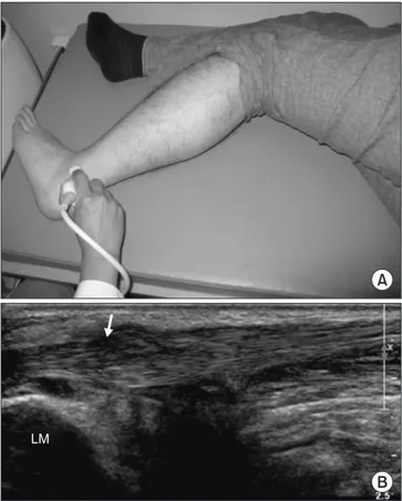 Figure 7. (A) Ultrasonography of peroneal tendon was performed in  lateral decubitus position with hip and knee flexion
