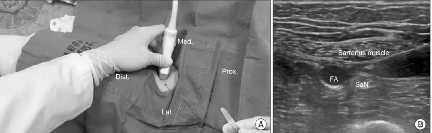Figure 1. Adductor canal block. (A) Adductor canal block using ultrasonography; place the epidural catheter after the adductor canal block