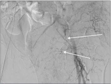 Figure 5. No active arterial bleeding was observed on the left internal iliac  angiogram after successful embolization of the corona mortis (arrows)