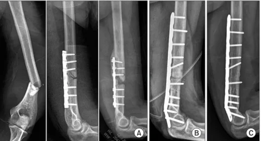 Figure 1. (A) A nonunion of distal humeral  shaft with screw breakage was shown  after internal fixation