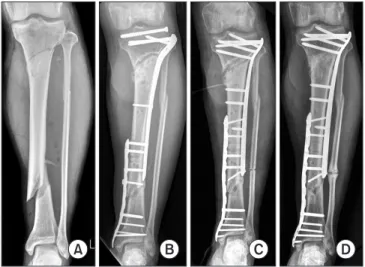Figure 3. (A, B) For a segmental tibial shaft fracture, plate fixation was  performed; however, hypertrophic nonunion occurred with insufficient  numbers of screws and relatively short length of plate