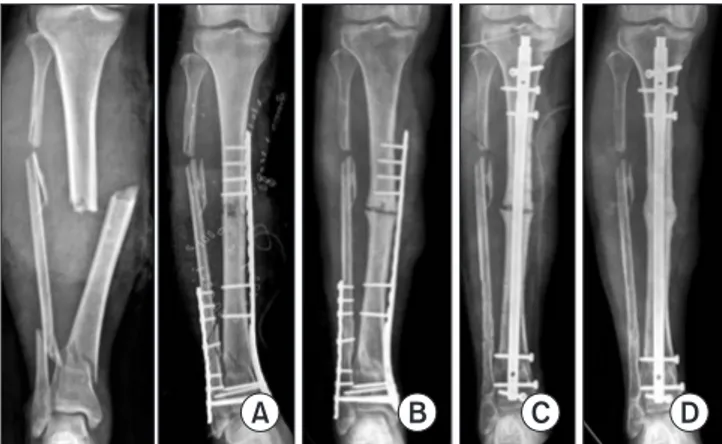 Figure 7. (A, B) After intramedullary nailing for a distal femoral shaft  fracture, a hypertrophic nonunion of the femur was observed, probably  from insufficient working length of distal fixation
