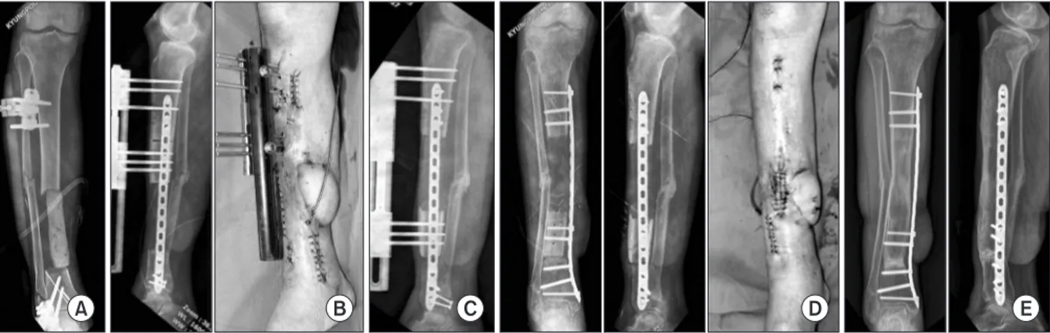 Figure 9. (A) A nonunion with segmental bone defect occurred after the management of open tibia fracture