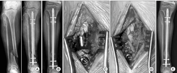 Figure 10. Nailing was done in open fracture of the distal tibia (A); however, the atrophic nonunion occurred without callus formation on the radiograph  (B)