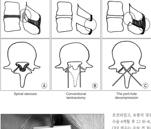 Figure 1. Port-hole decompression is  different from the conventional  laminec-tomy. (A) The figure show spinal stenosis  with thickened ligamentum flavum and  hypertrophied facet joints