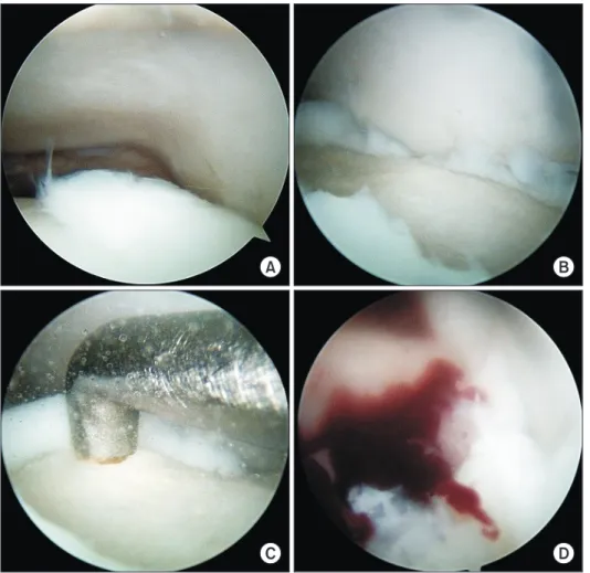 Figure 2. Arthroscopic microfracture. (A)  Arthroscopic view of the osteochondral  lesion of the talus
