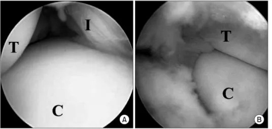 Figure 2. Arthroscopic findings showing  the inside view of the subtalar joint. 