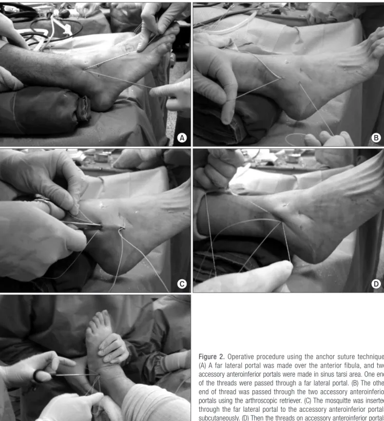 Figure 2. Operative procedure using the anchor suture technique. 