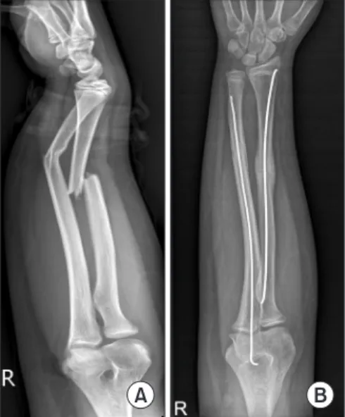 Figure 1. (A) Radiography showing broken forearm bones of a 12-year- 12-year-old boy falling from a trampoline