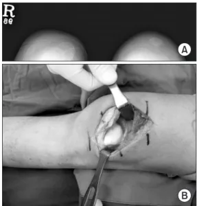 Figure 1. (A) Lateral dislocation on Merchant view. (B) Trochlear  hypoplasia.