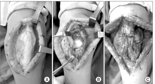 Figure 3. (A) Lateral dislocation before  the procedure. (B) Trochlear hypoplasia  was observed after lateral release