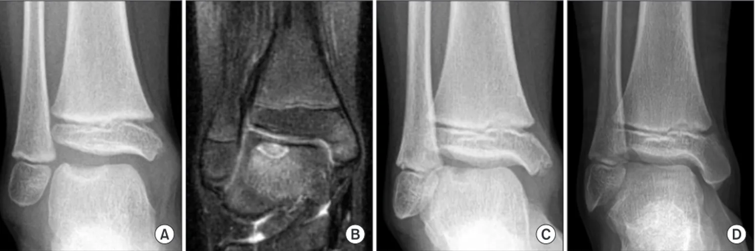 Figure 1. Case of a 6-year-old boy treated conservatively. (A) Initial anteroposterior (AP) radiograph of the ankle joint showing a large osteolytic lesion with  a sclerotic rim in the lateral aspect of the talar dome
