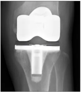 Figure 1. To compare the degree of polyethylene wear, the distance  from the lowest end of the medial condyle of the femoral component to  the tibial component and the distance from the lowest end of the lateral  condyle of femoral component to the tibial 