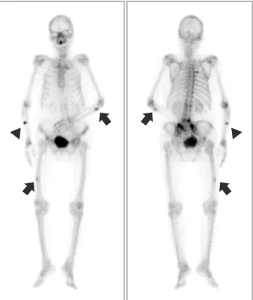 Figure 2. Sagittal image of computed tomography also shows cortical  thickening and marginal sclerosis at the transverse fracture line.