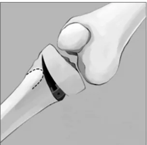 Figure 9. During uniplanar osteotomy, a metal block is fixed to the plate  using screw.