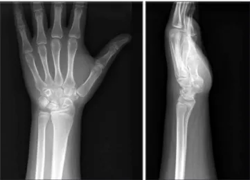 Figure 2. (A) Sagittal computed tomography image shows bony  fragmentation of the lunate bone