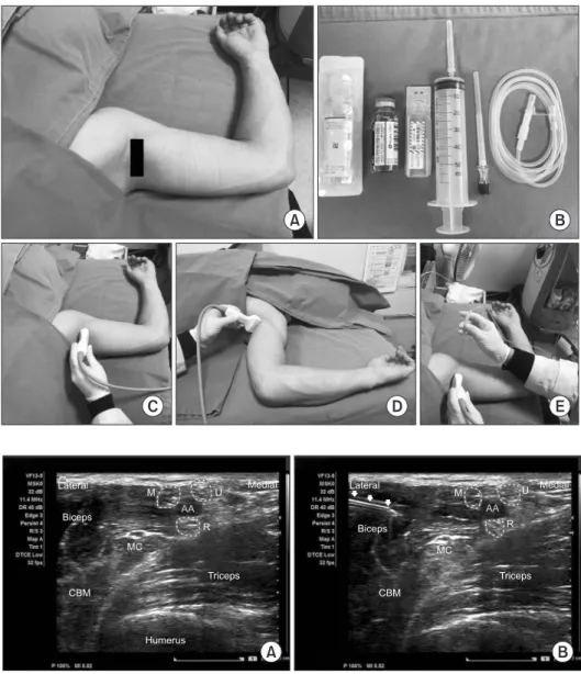 Figure 1. (A, C, D) Patient position and the  location of the probe for performing axillary  brachial plexus block