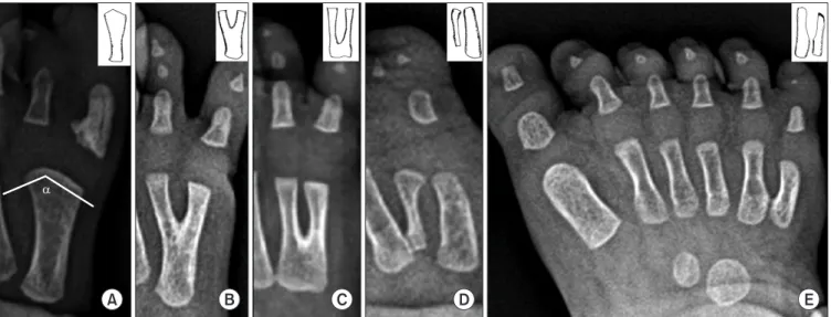 Figure 2. Five different deformity types. (A) The angle between two separate articular surfaces (α angle) was measured for the widened metatarsal  head type
