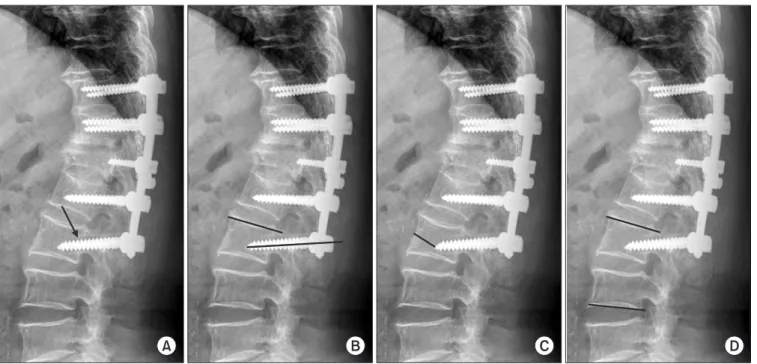 Figure 1. Radiographic parameters. (A) The halo around the distal screw was checked by a radiolucent width from the screw thread end (arrow)